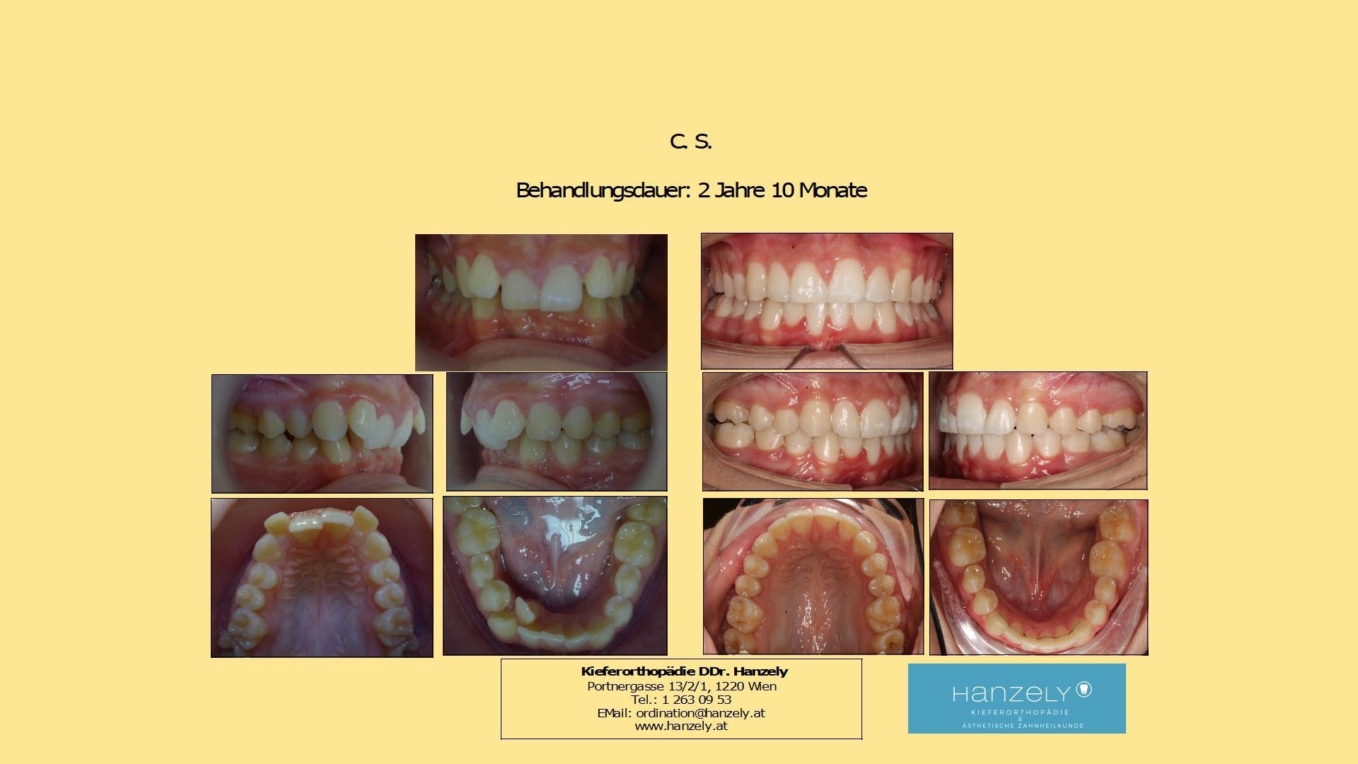 Engstand im Unterkiefer (IOTN 4d)
