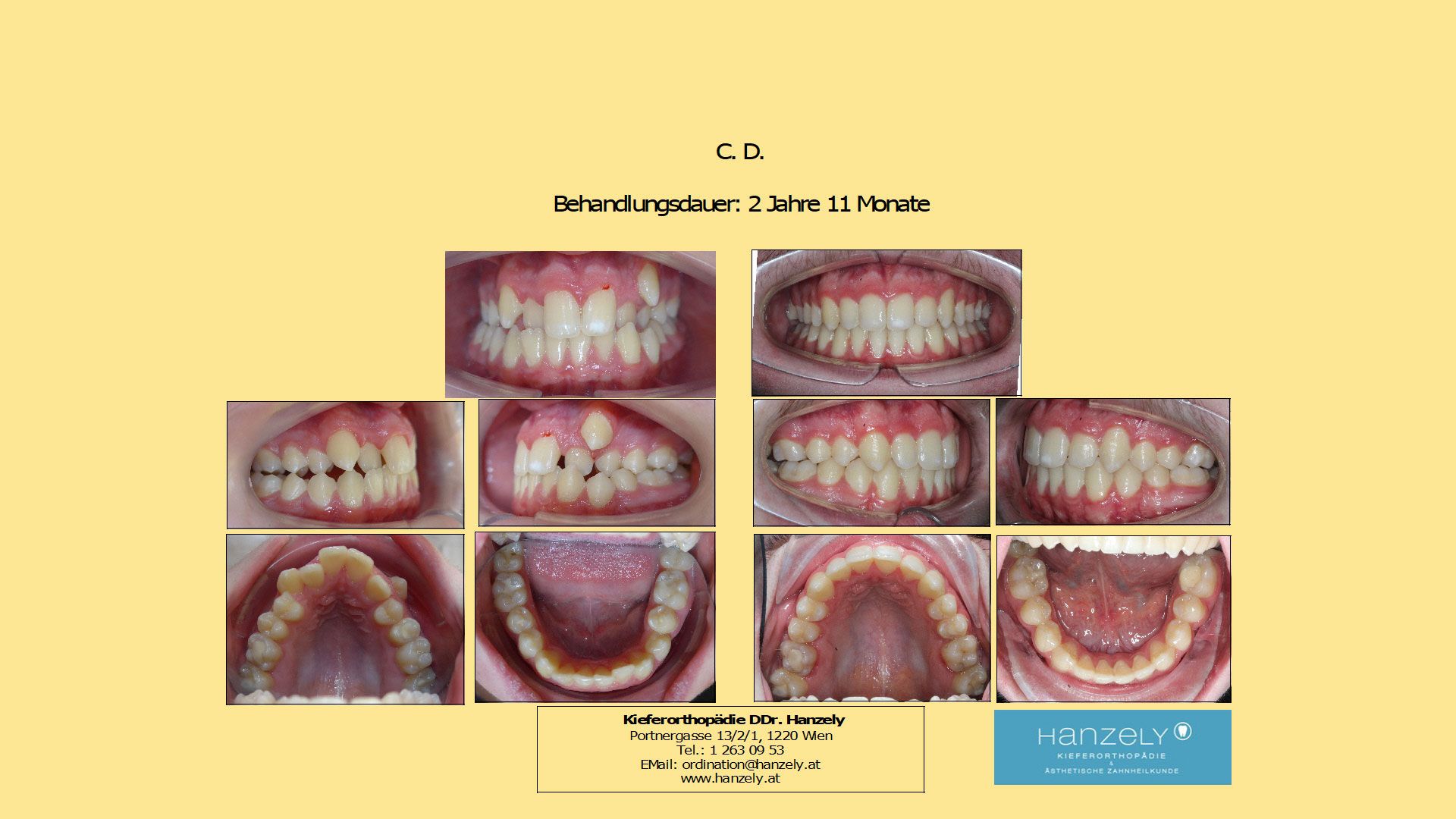 Außenstehender_Eckzahn_mit_Kreuzbiss__IOTN_4t_