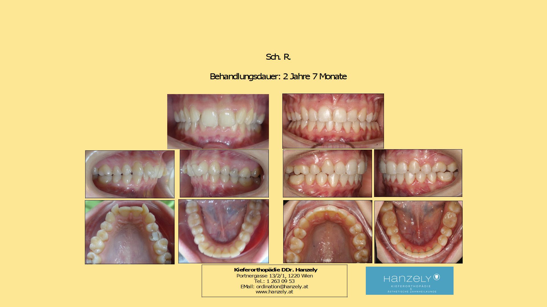 Vergrößerter Überbiss mit Zahnziehen (IOTN 4a)