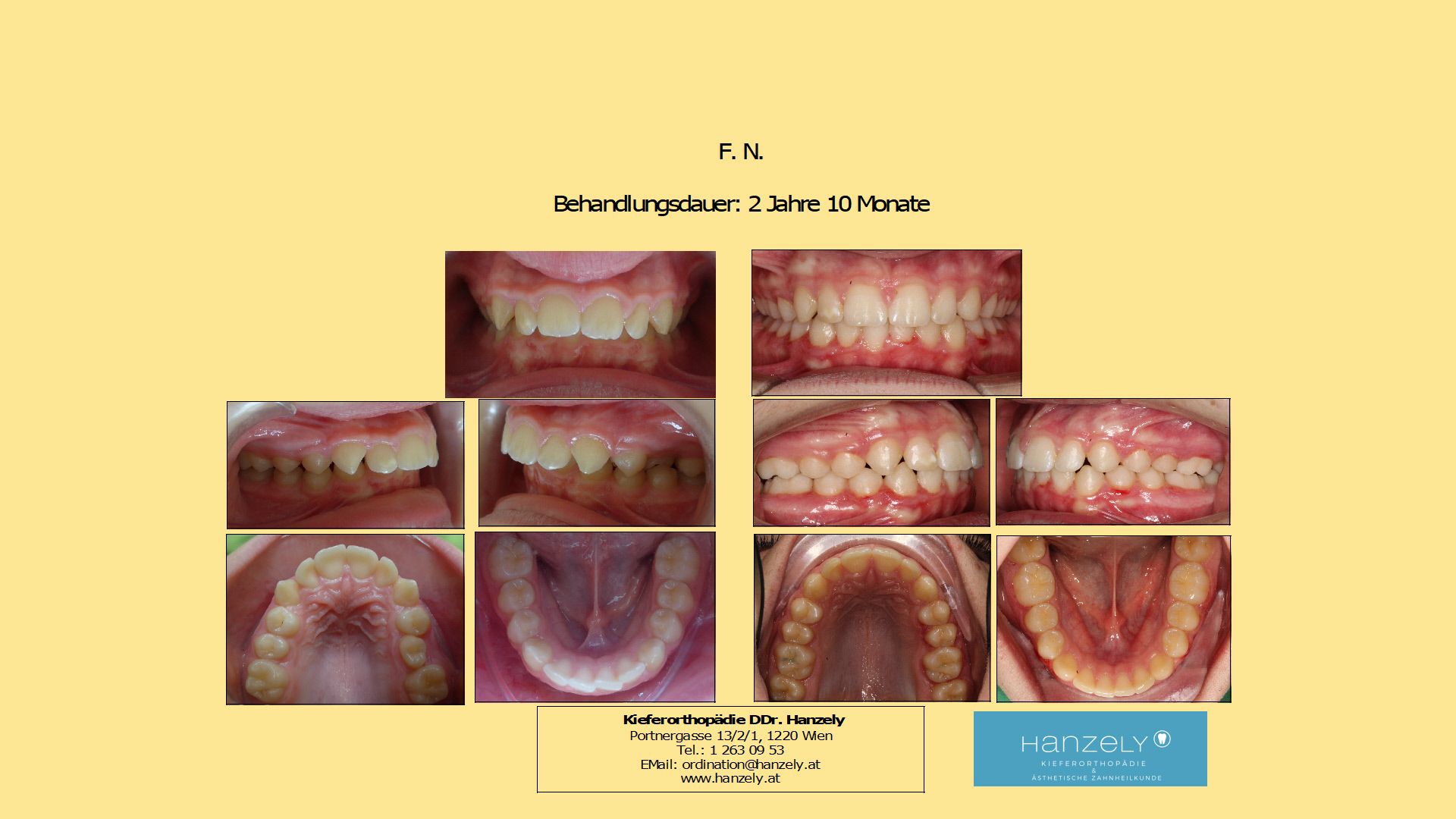 Vergrößerter Überbiss ohne Zahnziehen (IOTN 4a)