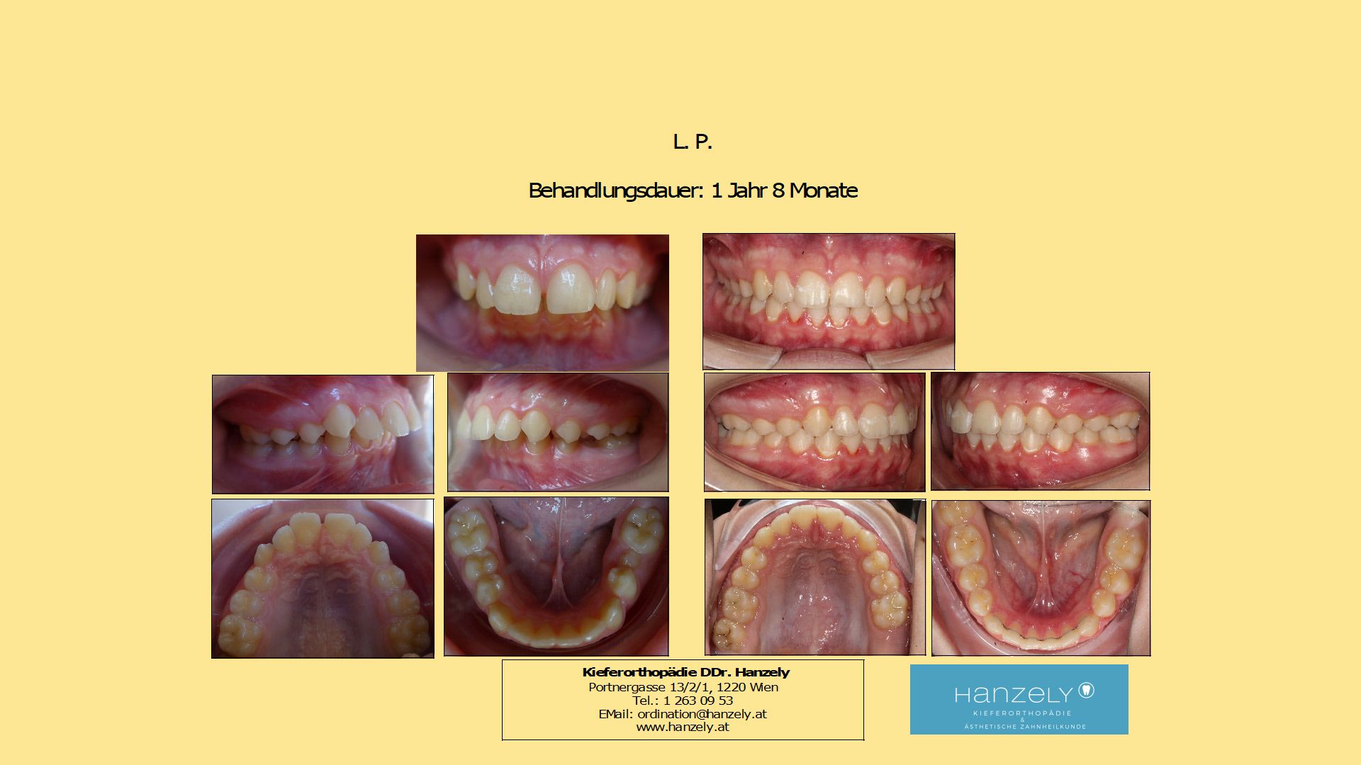 Vergrößerter Überbiss ohne Zahnziehen (IOTN 4a)