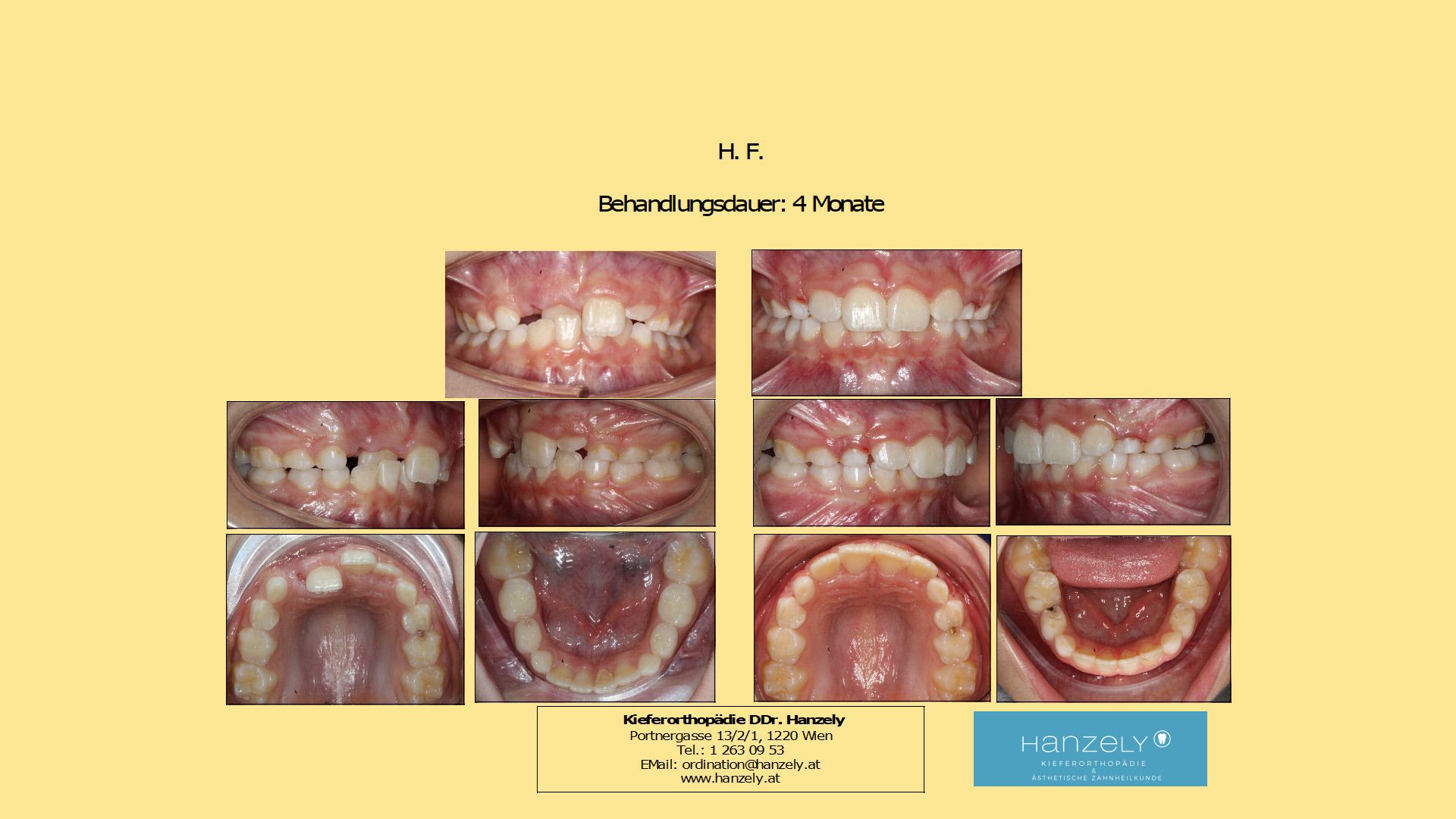 Frontaler Kreuzbiss, Vorbehandlung (Interzeptive Behandlung, IB) (IOTN 4c)
