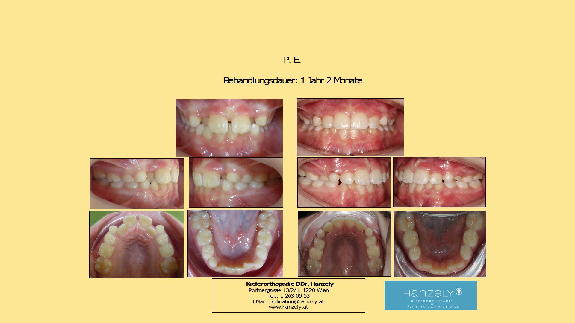 Starker frontaler Engstand mit Kreuzbiss, Vorbehandlung (Interzeptive Behandlung, IB) (IOTN 4c)