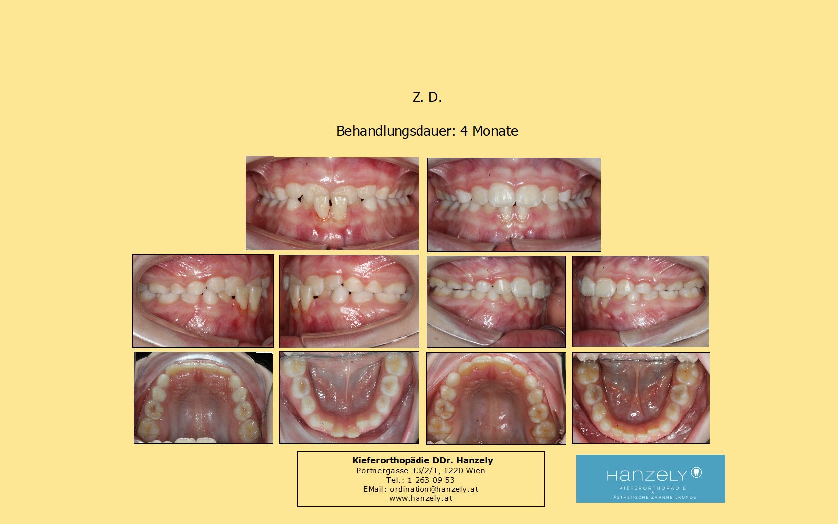Frontaler Kreuzbiss, Vorbehandlung (Interzeptive Behandlung, IB) (IOTN 4c)
