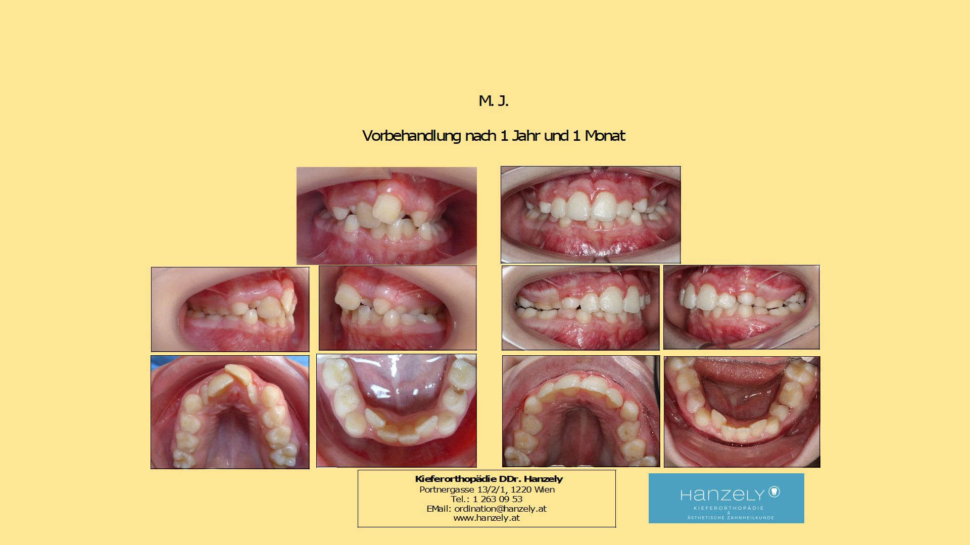 Starker frontaler Engstand mit Kreuzbiss, Vorbehandlung (Interzeptive Behandlung, IB) (IOTN 4c)