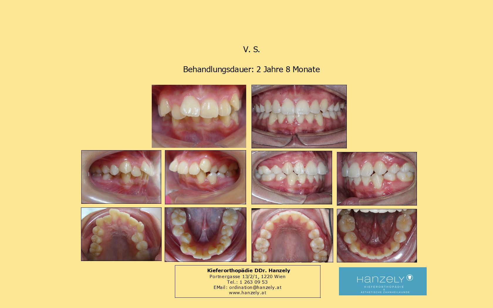 Starker Engstand Oberkiefer und Unterkiefer (IOTN 4d)