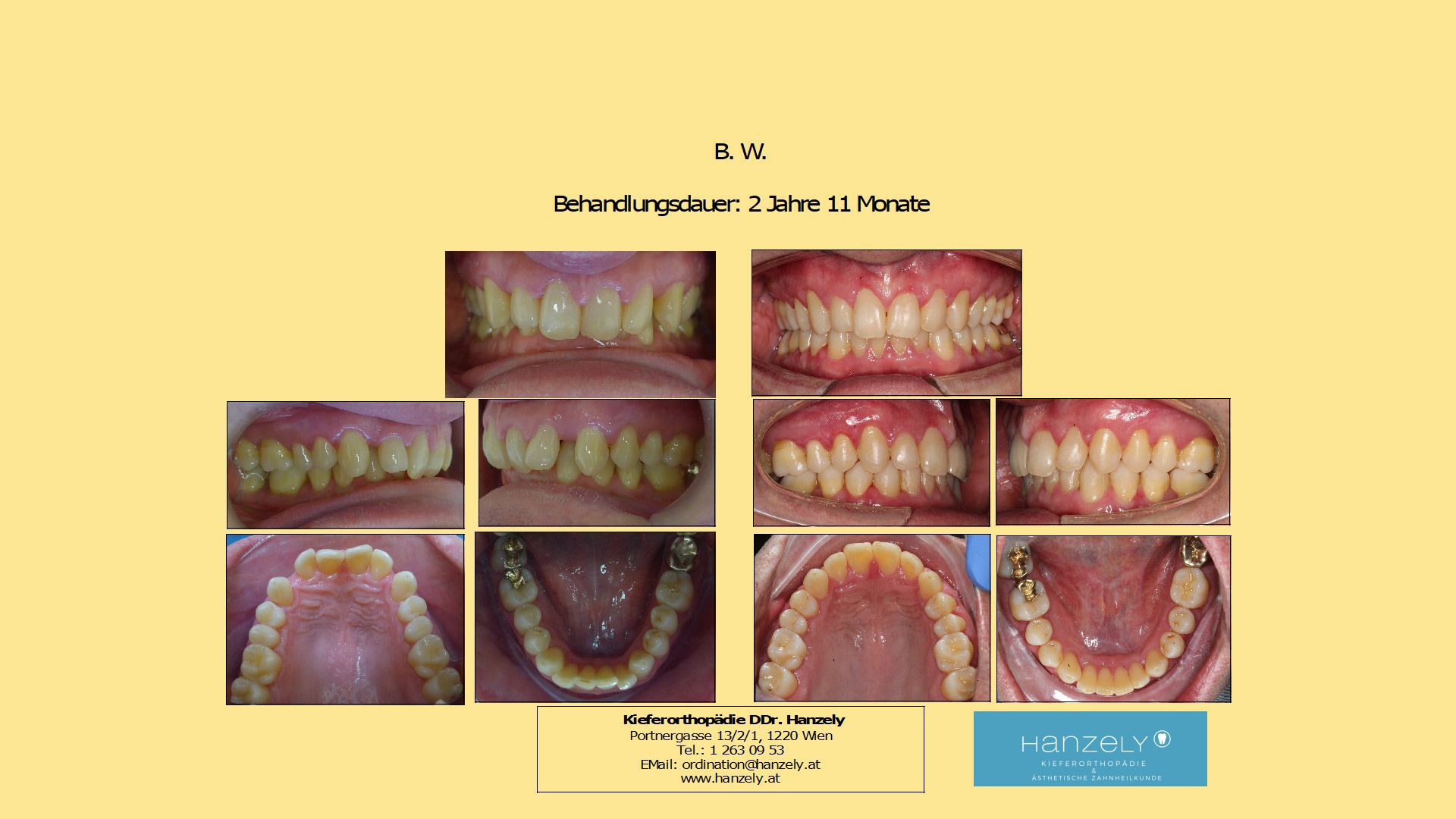 Tiefbiss bei Erwachsene (IOTN 4f)