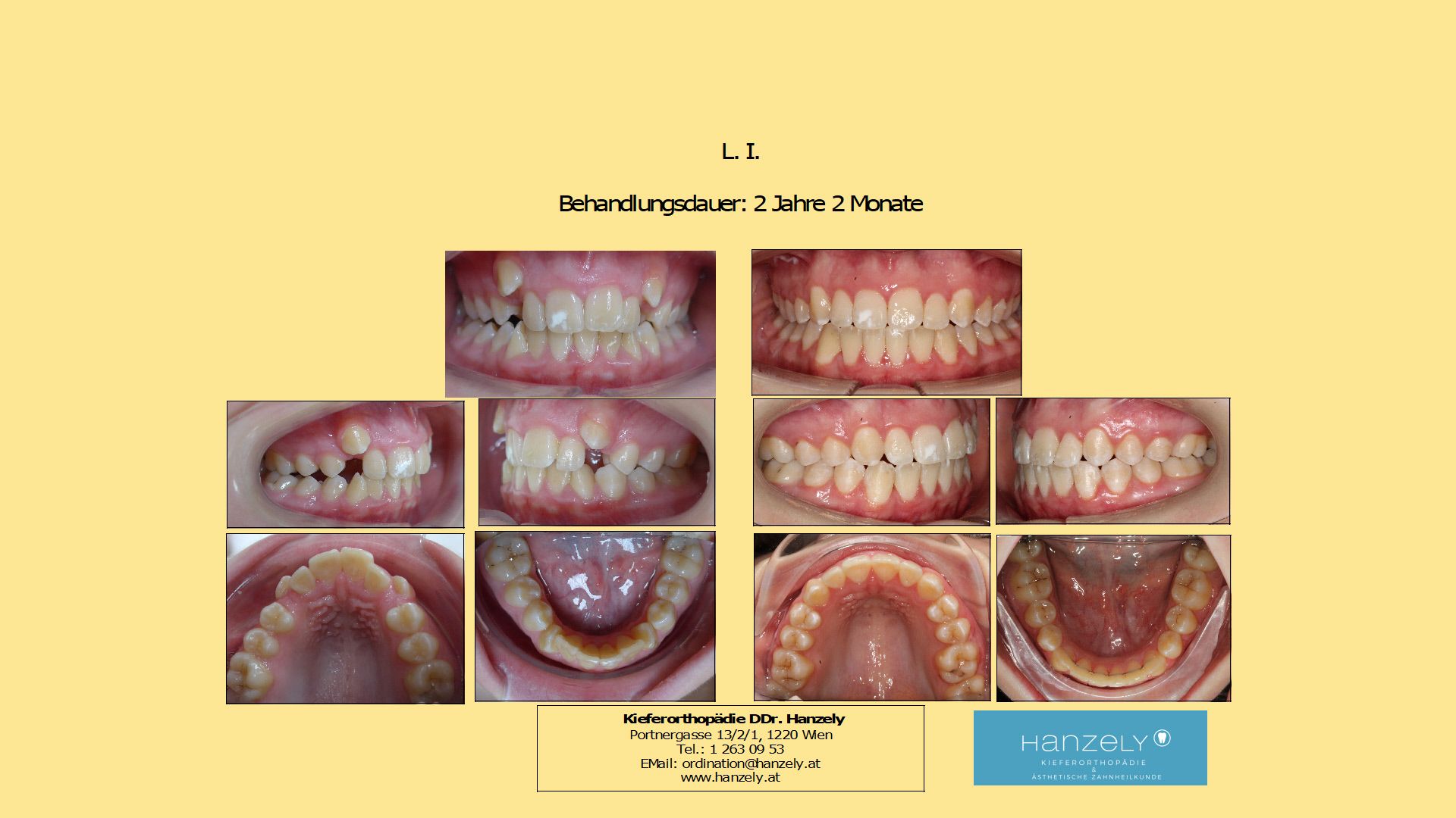 Außenstehende Eckzähne (IOTN 4t)