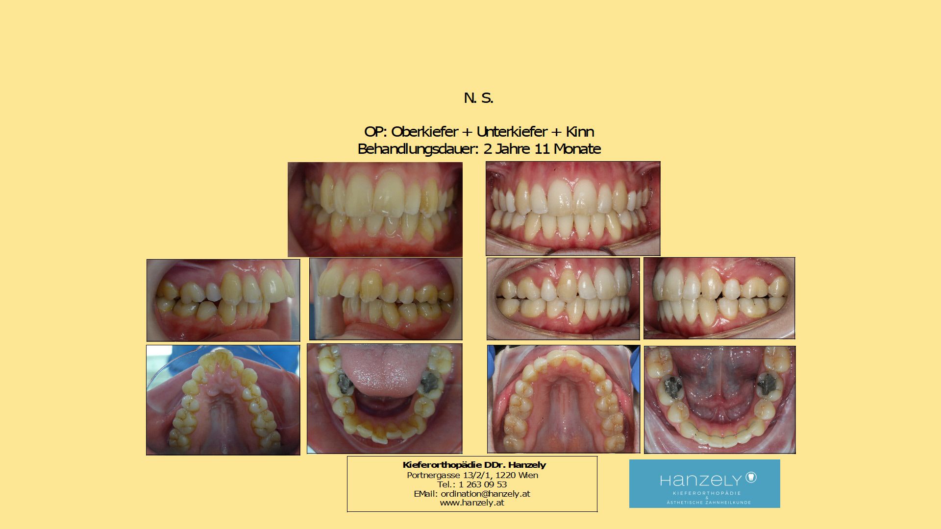 Operation Orthognathe Chirurgie, Oberkiefer + Unterkiefer OP (IOTN 5a)