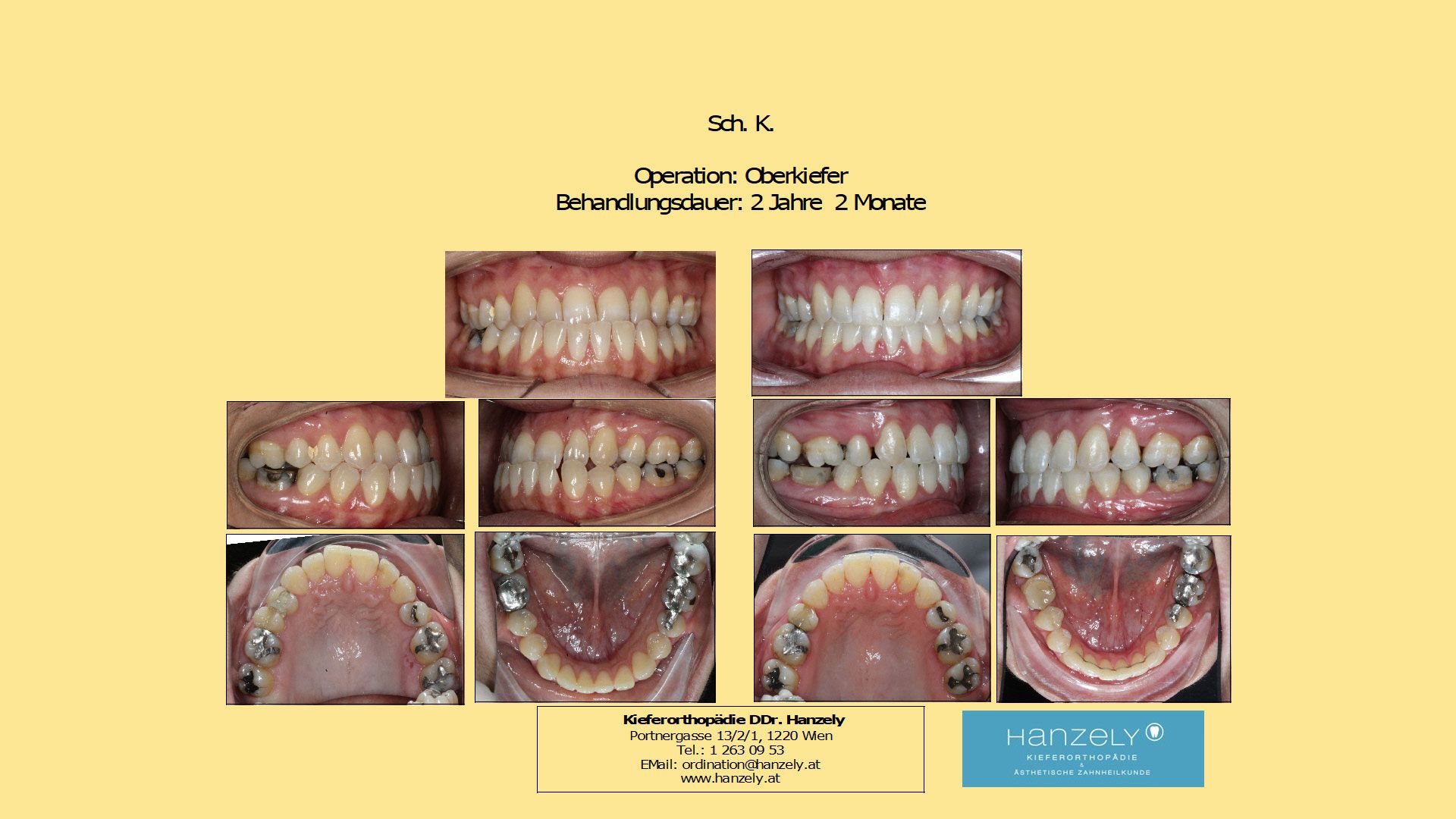 Operation_Orthognathe_Chirurgie__Oberkiefer_OP_wegen_frontalem_Kreuzbiss__IOTN_4c_
