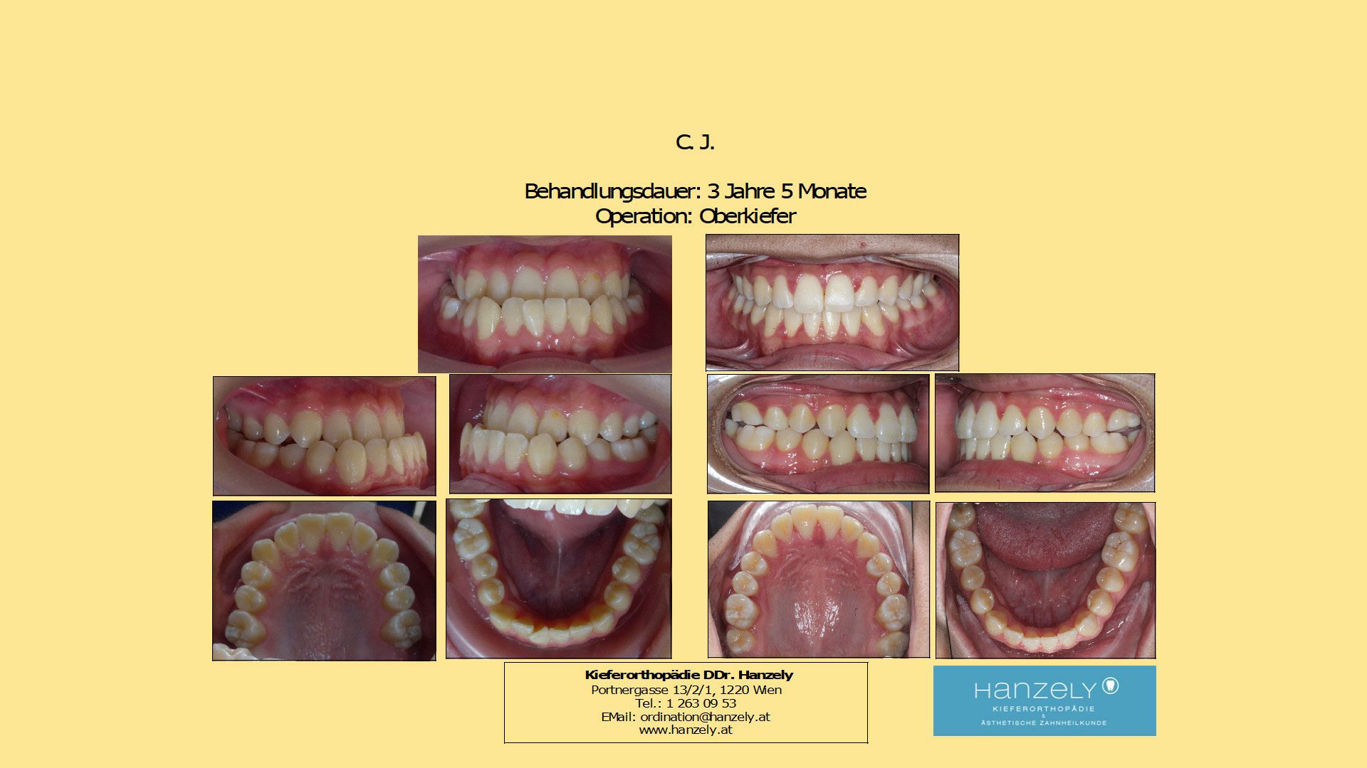 Operation_Orthognathe_Chirurgie__Oberkiefer_OP_wegen_verkehrtem_Biss__IOTN_5m_