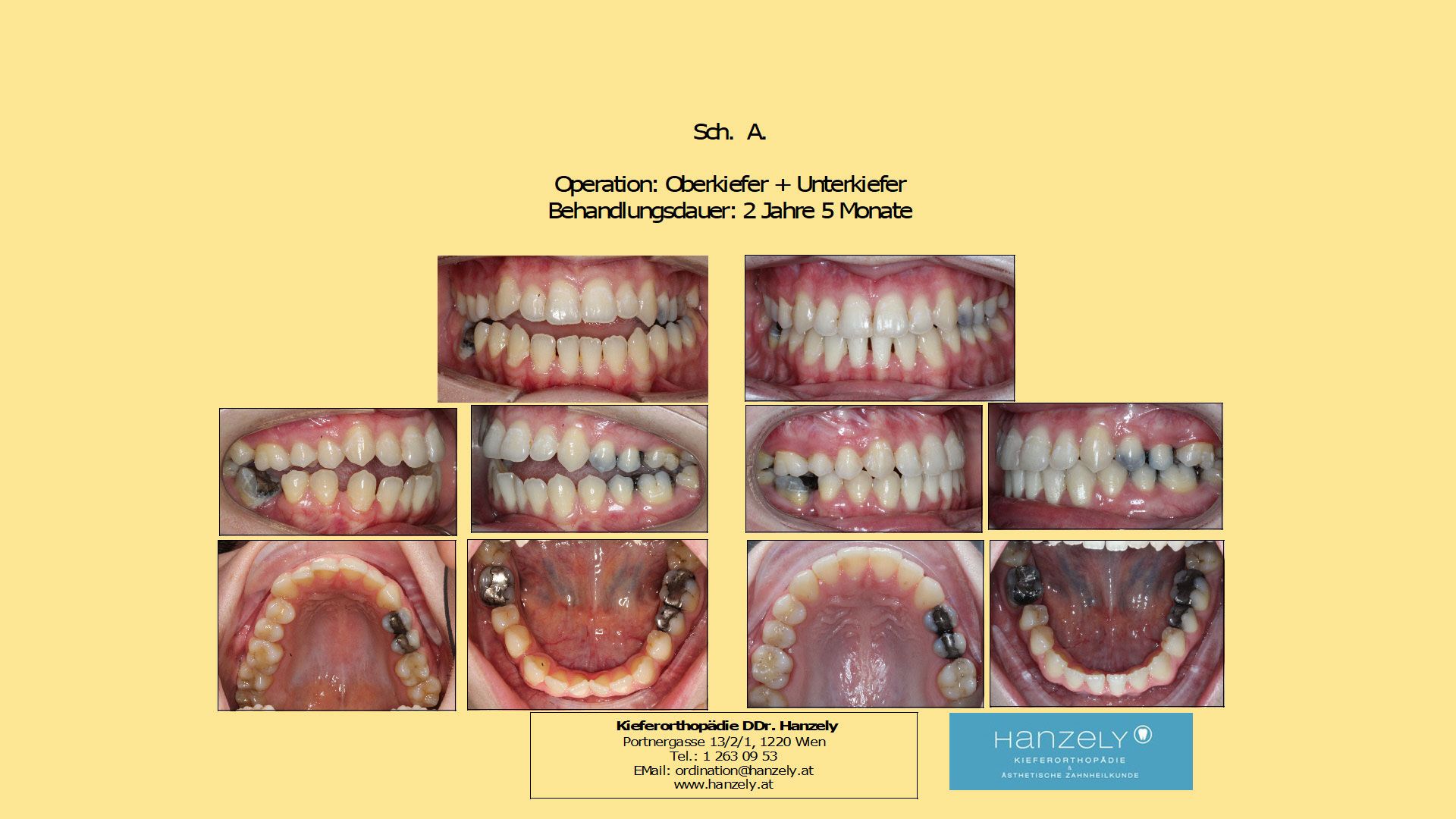 Operation_Orthognathe_Chirurgie__Oberkiefer_+_Unterkiefer_OP_wegen_frontal_offenem_Biss__IOTN_4c_