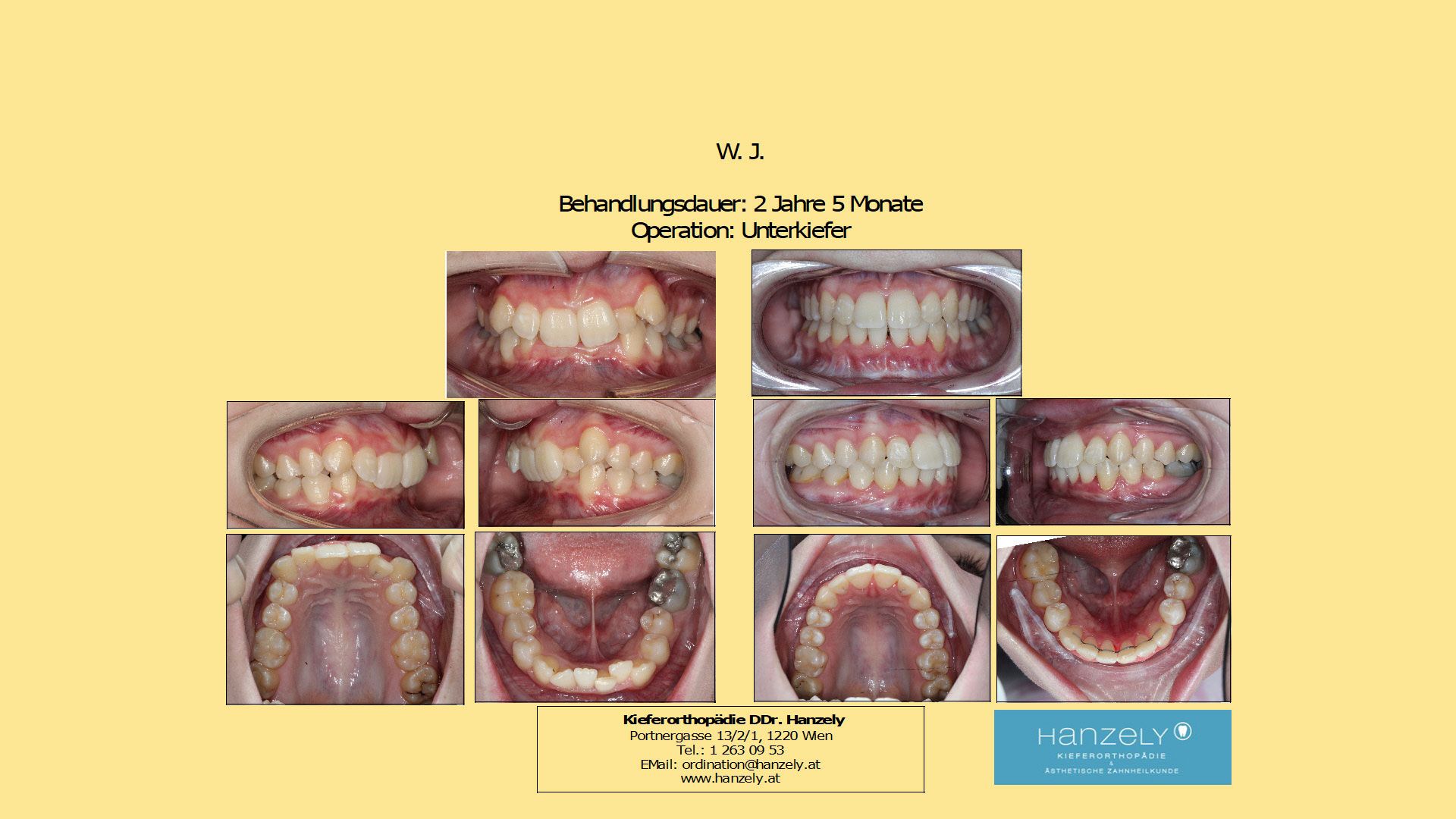 Operation_Orthognathe_Chirurgie__Unterkiefer_OP_wegen_starkem_Tiefbiss__IOTN_4f_