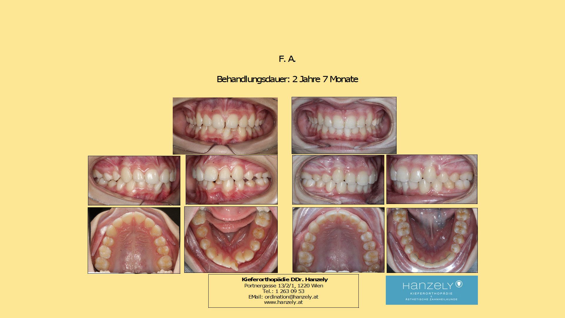 Stark_rotierter_Unterkiefer_Frontzahn__IOTN_4d_