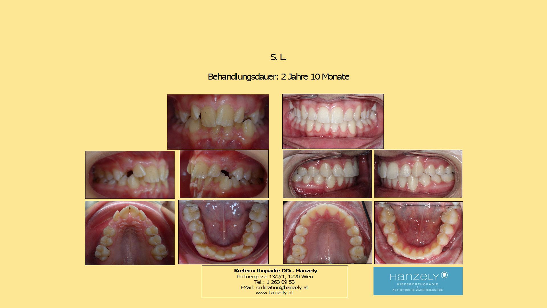 Starker_Engstand_Oberkiefer_und_Unterkiefer__IOTN_4d_