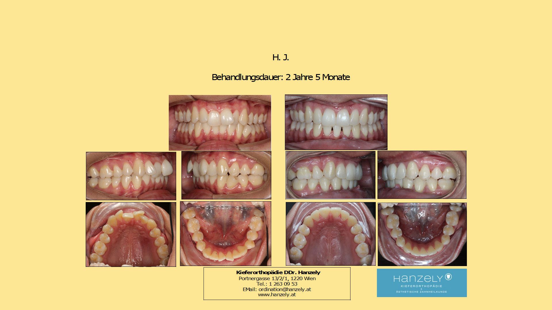 Starker_Engstand_Oberkiefer_und_Unterkiefer_mit_einseitigem_Zahnziehen__IOTN_4d_