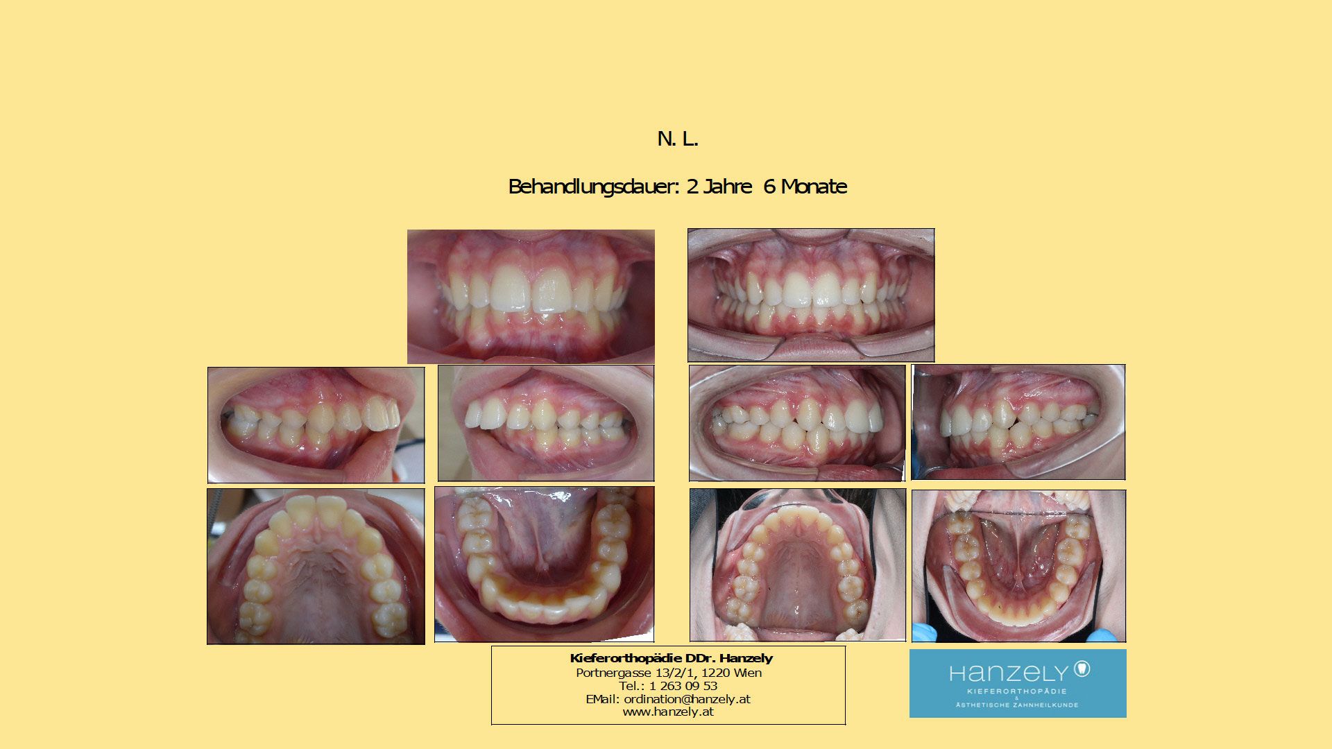 Vergrößerter_Überbiss_ohne_Zahnziehen__IOTN_5a_