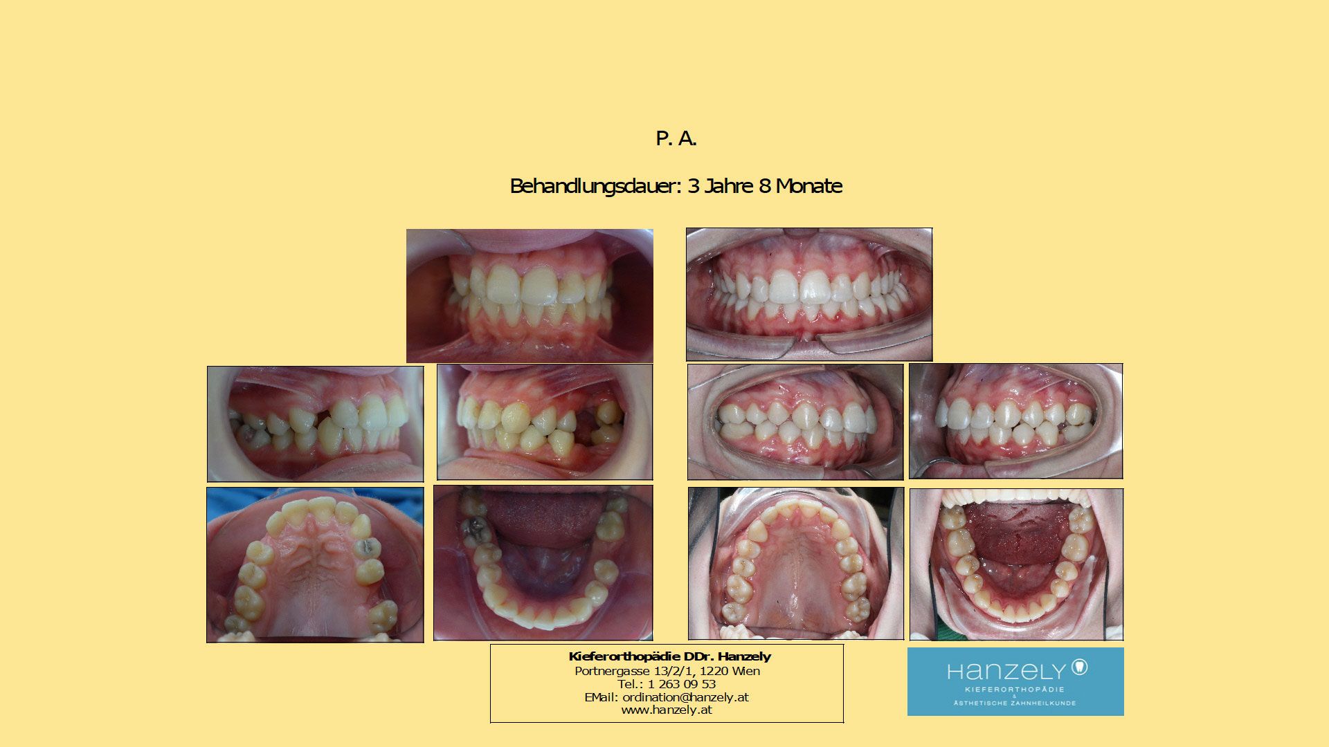 Verlagerter_Eckzahn_im_Gaumen__IOTN_5i_